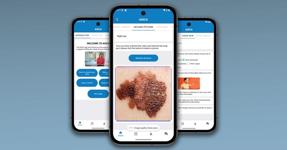 Skin cancer survivors invited to help evaluate new follow-up phone app